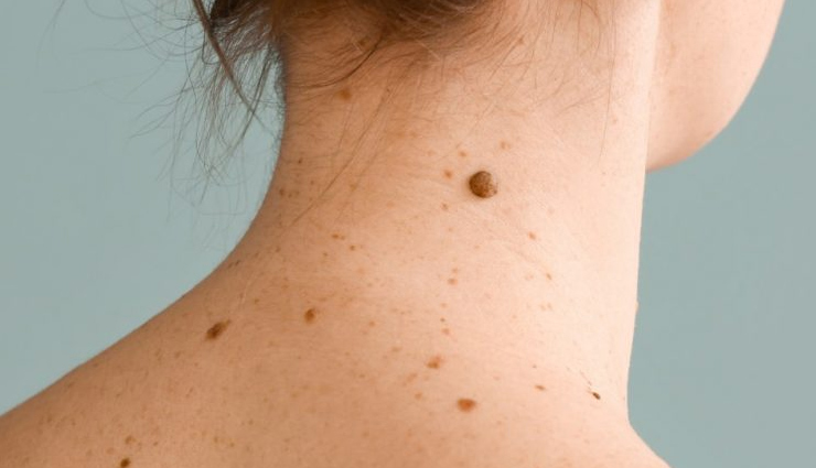 इन 10 उपायों की मदद से बिना ऑपरेशन के हटाए त्वचा पर पनपे मस्से