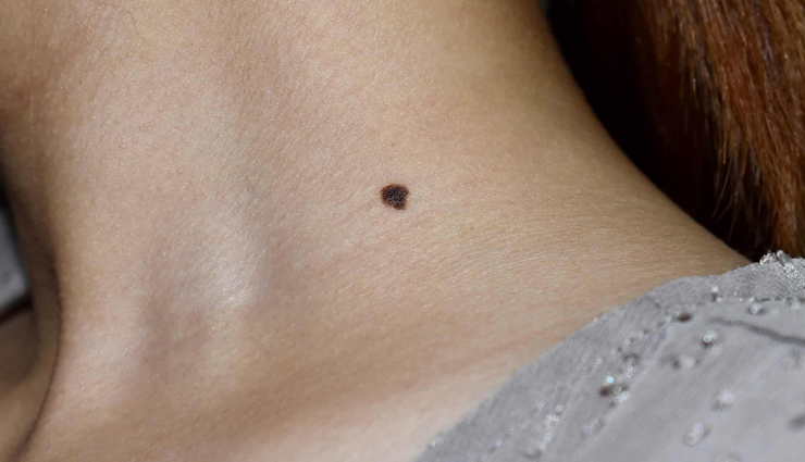 home treatments for removing moles,removing moles,tips to remove moles,dos and donts for moles,beauty tips,beauty hacks