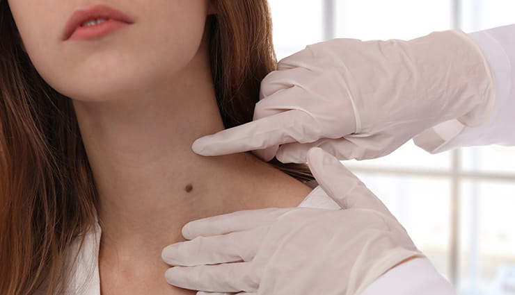 home treatments for removing moles,removing moles,tips to remove moles,dos and donts for moles,beauty tips,beauty hacks