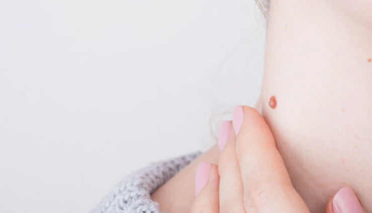 home treatments for removing moles,removing moles,tips to remove moles,dos and donts for moles,beauty tips,beauty hacks