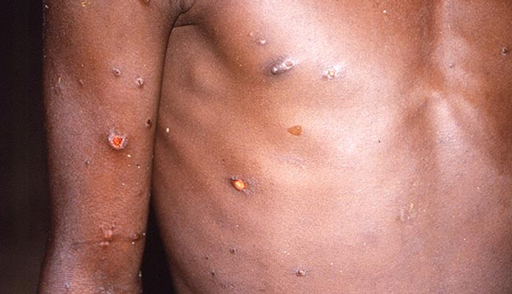 Monkeypox: कितना खतरनाक, क्या है लक्षण-इलाज, आपके मन में उठ रहे इन 10 बड़े सवालों के ये हैं जवाब