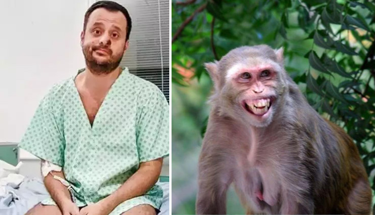 103 डिग्री बुखार, असहनीय दर्द, रोंगटे खड़े कर देगी मंकीपॉक्स की चपेट में आए उत्तरी लंदन के एक सेक्सुअल हेल्थ वर्कर की कहानी 