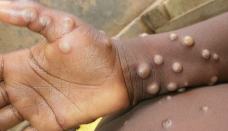 Monkey pox  की यूपी में दस्तक, गाजियाबाद में 5 साल की बच्ची में दिखे लक्षण, स्वास्थ्य विभाग ने जांच के लिए भेजे सैंपल 