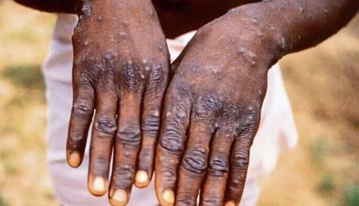 Monkeypox: इन 5 में से एक भी लक्षण दिखे तो हो जाए सावधान, जानें क्या-क्या हो सकती हैं परेशानियां? जरुरी बातें