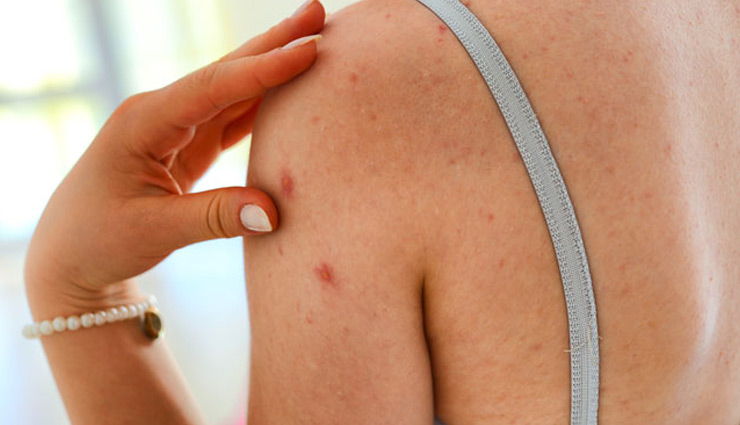 7 Major Symptoms of Monkeypox To Know