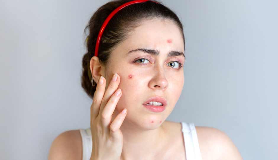 15 Home Remedies to Treat Monsoon Acne Naturally