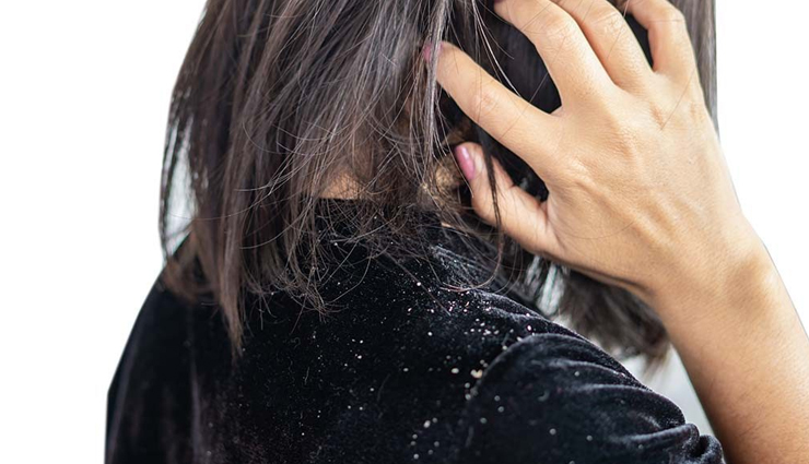 4 Tips To Help You Prevent Monsoon Dandruff