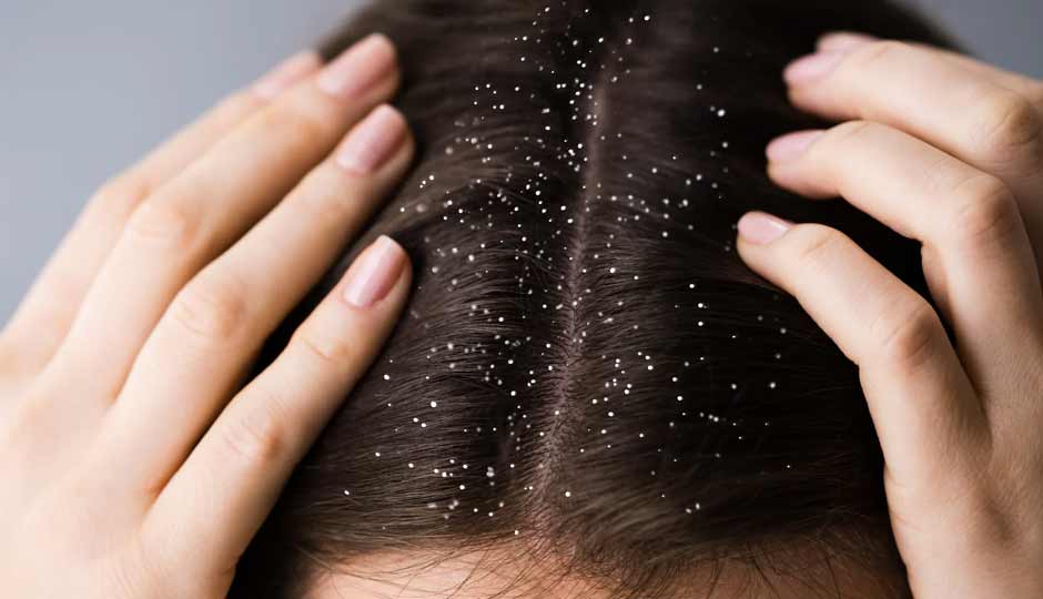 6 Effective Home Remedies To Treat Dandruff in Monsoon