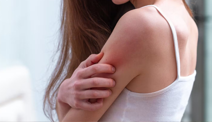 10 Common Skin Problems During the Monsoon Season and Effective Home Remedies to Get Rid of Them