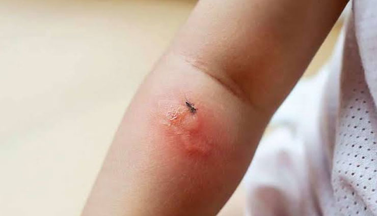 remedies to treat mosquito bite,instant remedies,mosquito bite,Health tips,fitness tips,home remedies