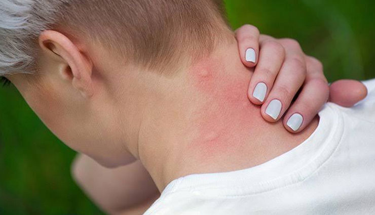 5 Instant Remedies To Treat Mosquito Bite