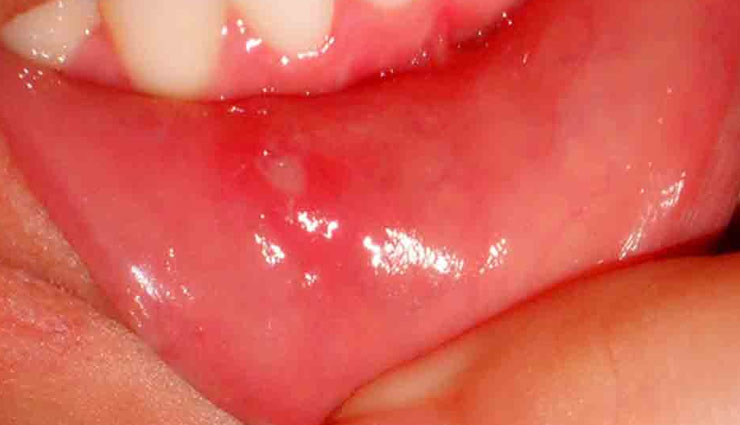 मुंह के छाले बन रहे है परेशानी का कारण, पाए इन उपायों से आराम Health tips,treat mouth ulcers,mouth ulcers,home remedies