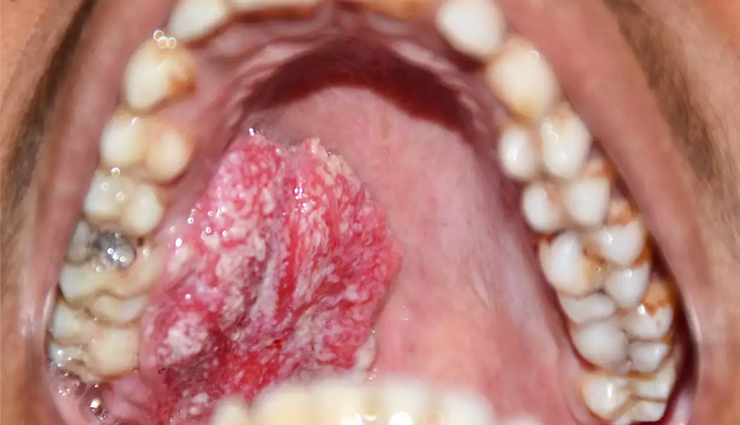 आम बात है मुँह का कैंसर होना, समय रहते किए गए इलाज से बचाया जा सकता है स्वयं को