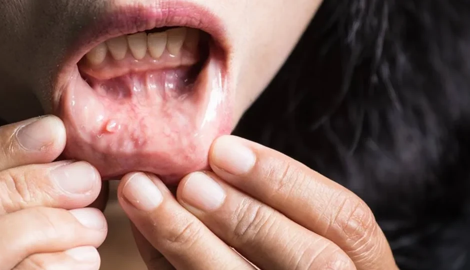 मुंह में दिख रहे ये 6 संकेत बताते हैं शरीर में पोषण की कमी, तुरंत लें डॉक्टर की सलाह