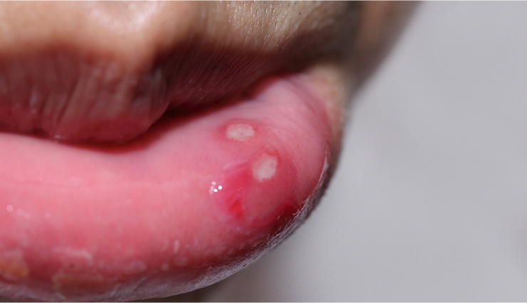 home tips,6 way treat mouth ulcer,mouth ulcer