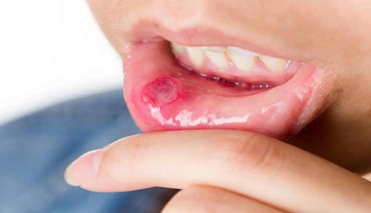 गर्मियों में बड़ी परेशानी बनते हैं मुंह के छाले, ये प्राकृतिक उपाय दिलाएंगे आपको राहत