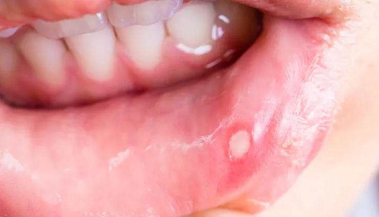 मुँह से निकलती दुर्गंध से खत्म होती है सामाजिकता, जानिये इसके कारण और निदान reasons for bad breath,home remedies for bad breath,how to get rid of bad breath naturally,causes and cures for halitosis,bad breath remedies at home,natural ways to freshen breath,home treatments for halitosis,tips to cure bad breath naturally,home remedies for chronic bad breath,halitosis causes and home solutions