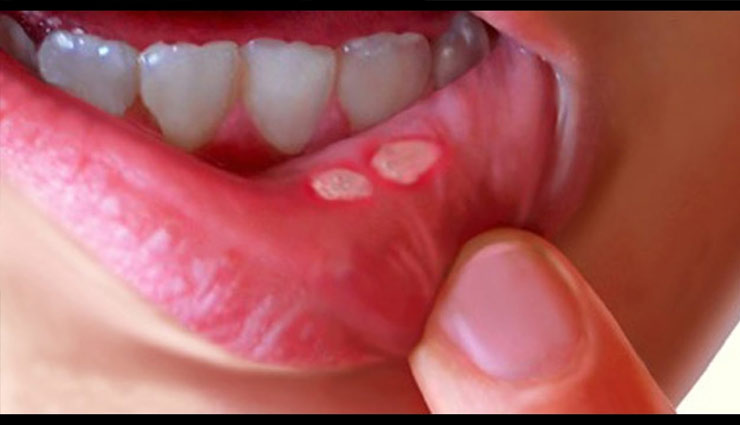 home remedies to treat mouth ulcer,mouth ulcers,home remedies. heathy living