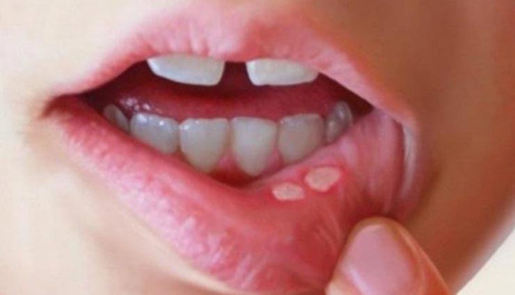 मुंह के छाले कर रहे हैं परेशान, रसोई की इन 5 चीजों से मिलेगी राहत