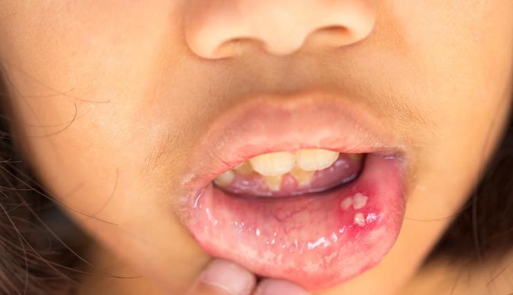 Health tips,health tips in hindi,mouth ulcers,mouth ulcers remedies,home remedies