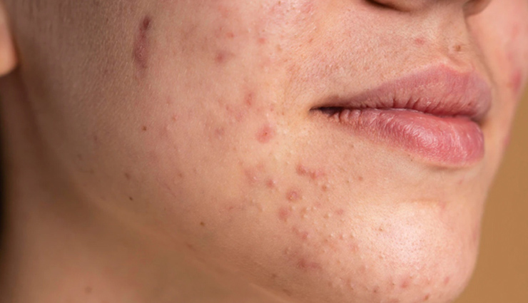 मुंहासों के कारण बन चुके हैं गाल में गड्ढे, इन घरेलू उपायों से करें इन्हें दूर 