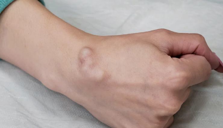 कोलेस्ट्रॉल जब बढ़ जाए हद से ज्यादा तो हाथों-पैरों की उंगलियों पर दिखते हैं ये लक्षण, नजरअंदाज करना पड़ सकता है महंगा cholesterol symptoms extremities,warning signs of high cholesterol,cholesterol effects on fingers and toes,recognizing cholesterol-related symptoms,signs of elevated cholesterol levels,cholesterol symptoms in hands and feet,importance of detecting cholesterol symptoms,cholesterol indicators on fingers and toes,identifying cholesterol warning signs,cholesterol-related symptoms awareness