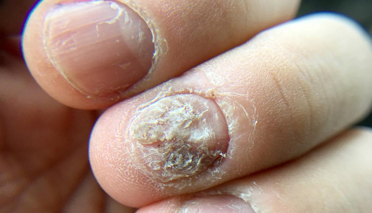 tea tree oil,tea tree oil beauty,tea tree oil beauty benefits,tea tree oil for skin,tea tree oil for skin beauty,beauty,beauty tips