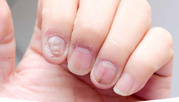7 Home Remedies To Treat Nail Infection