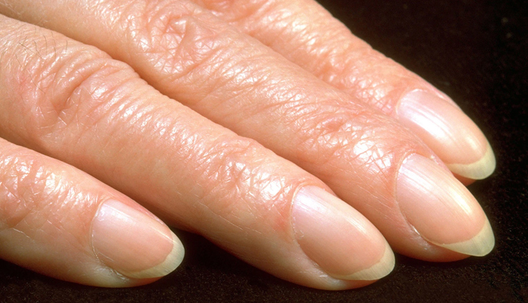 heart diseases that appear on your skin,heart diseases,healthy living,Health tips