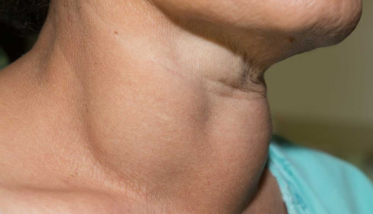 world thyroid day 2022,thyroid,hypothyroidism,hyperthyroidism,causes of thyroid,symptoms of thyroid,health news,healthy living