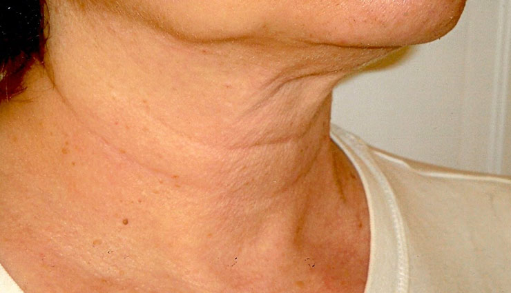beauty tips,skin care tips,home remedies,neck wrinkles,wrinkles remedies