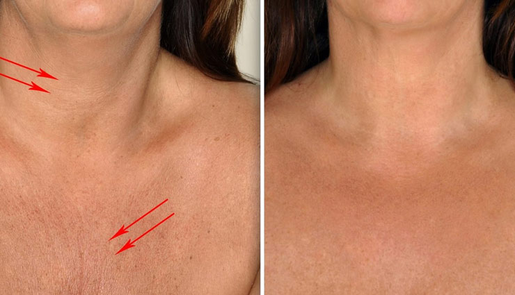 गर्दन में पड़ने वाली झुर्रियां घटा रही है आपकी सुंदरता, आजमाकर देखें ये असरदार ब्यूटी टिप्स 