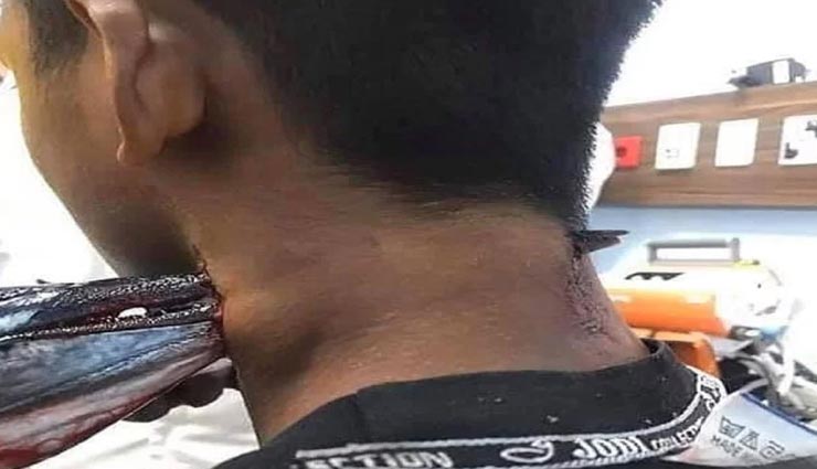 फिशिंग करना लड़के को पड़ा भारी, गर्दन के आरपार हुई मछली