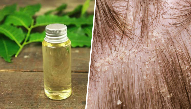 8 Different Ways to Use Neem Oil to Get Rid of Dandruff