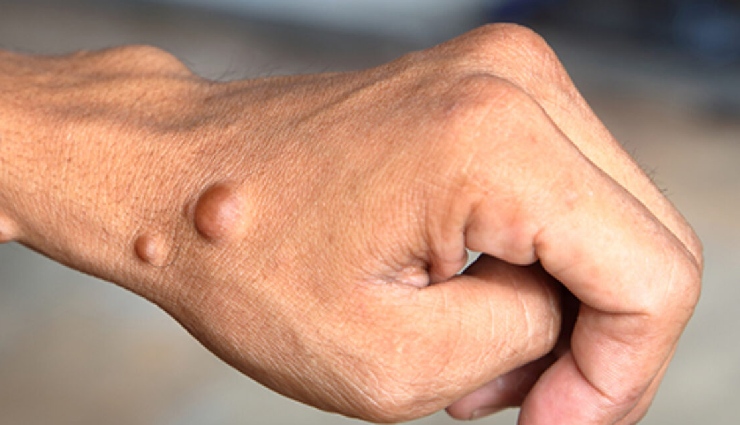 genetic disorders,inherited diseases,dna mutations,types of genetic disorders,common genetic conditions,monogenic disorders,multifactorial disorders,chromosomal abnormalities,genetic health risks,sickle cell anemia,cystic fibrosis,causes of genetic disorders,inherited health conditions