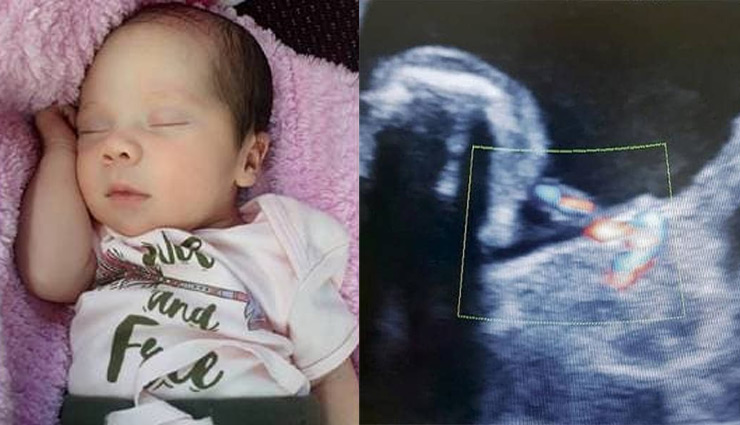 महिला ने दिया 'प्रेग्नेंट' बच्ची को जन्म, डॉक्टरों ने बेबी गर्ल का किया C सेक्शन