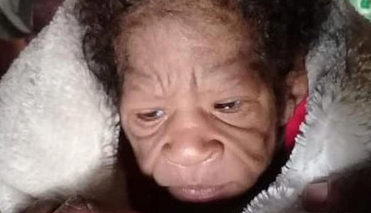 पैदा होते ही 60 साल की बूढ़ी महिला जैसी दिखने लगी बच्ची, पूरी चमड़ी में पड़ी हुई थी झुर्रिया 
