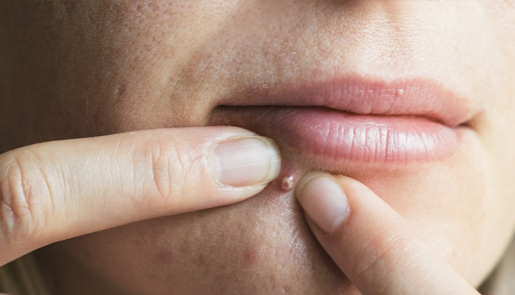 6 Natural Remedies To Nip Our Pimples in the Bud