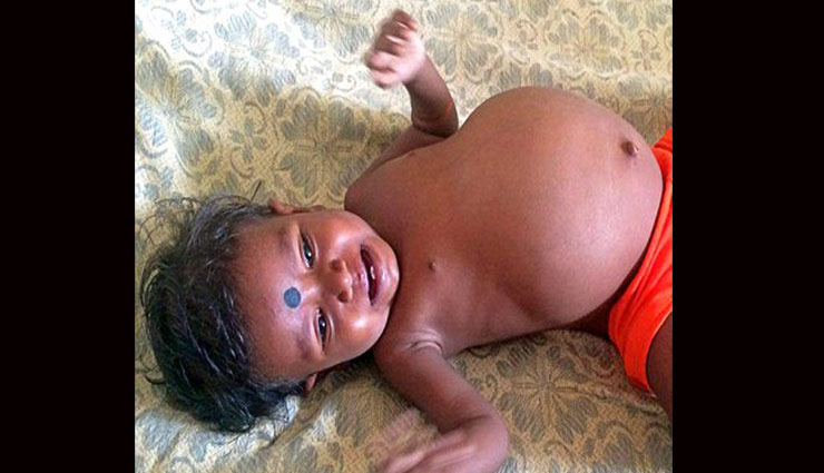 15 महीने की बच्ची के पेट में दो जुड़वां बच्चे, घटना देती है विज्ञान को चुनौती