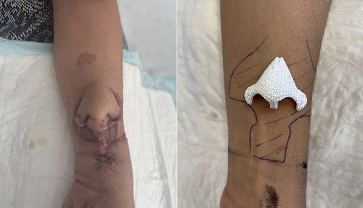 कैंसर के कारण काटनी पड़ी थी महिला की नाक, इस तकनीक का सहारा लेकर डॉक्टर्स ने दोबारा हाथ पर उगा दी