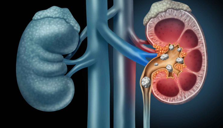 low risk conditions associated with obesity,obesity,Health tips,fitness tips