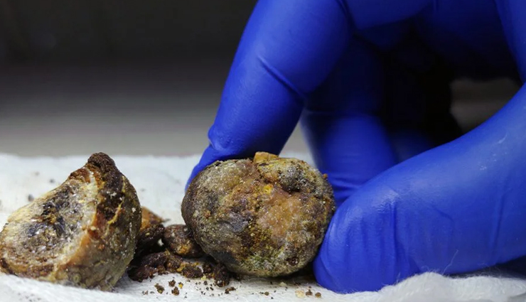 low risk conditions associated with obesity,obesity,Health tips,fitness tips