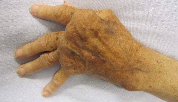 low risk conditions associated with obesity,obesity,Health tips,fitness tips