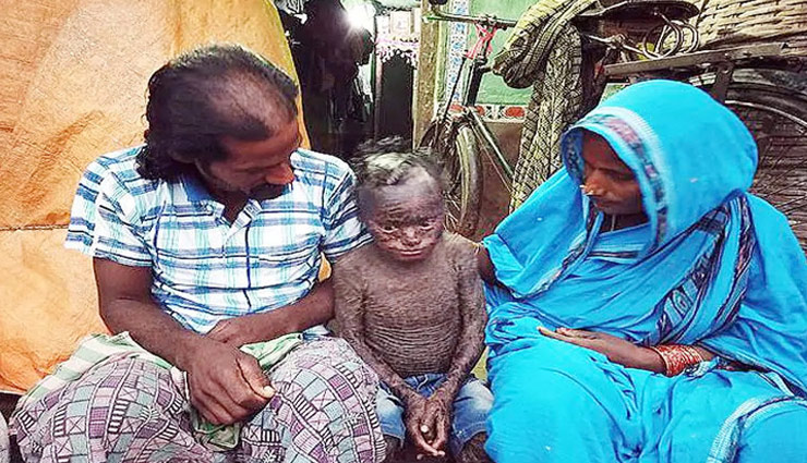 सांप की तरह खाल छोड़ता है यह बच्चा, इस खतरनाक बीमारी से है ग्रसित
