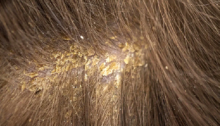 types of dandruff,dry scalp dandruff,oily scalp dandruff,fungal dandruff,psoriasis dandruff,seborrheic dermatitis,types of scalp conditions,dandruff causes,scalp health awareness,dandruff prevention tips