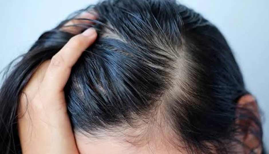 12 Home Remedies To Treat Oily Scalp