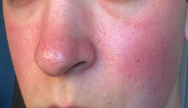 ऑयली स्किन से परेशान, पाना चाहते है खूबसूरती तो अपनाए ये घरेलू उपाय