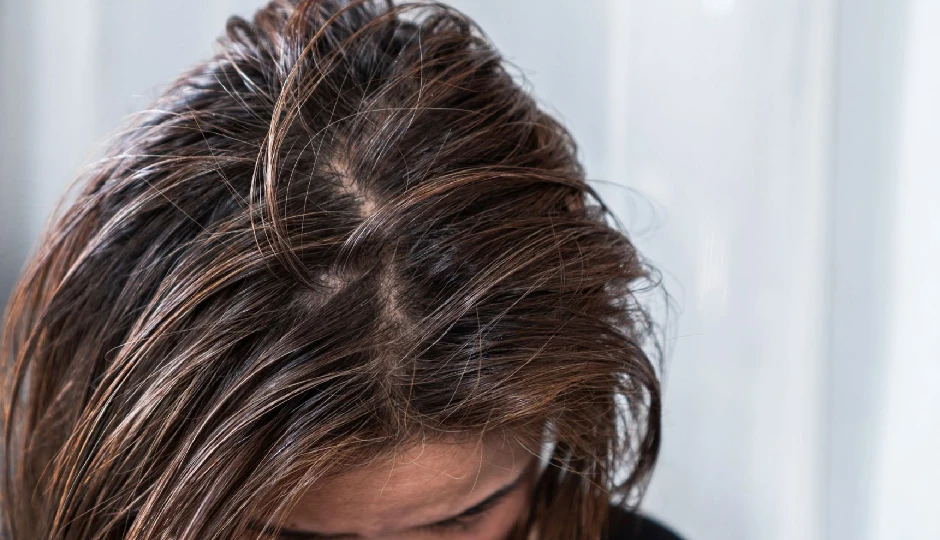 7 Effective Home Remedies To Treat Oily Scalp