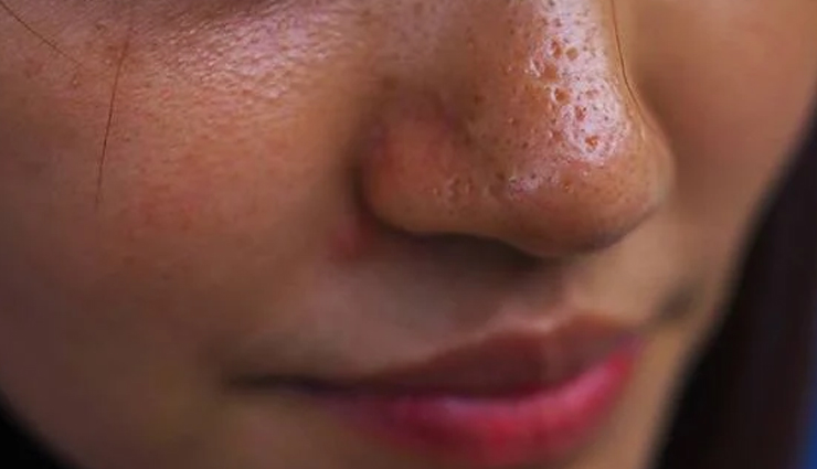 11 Effective Tips To Treat Oily Skin