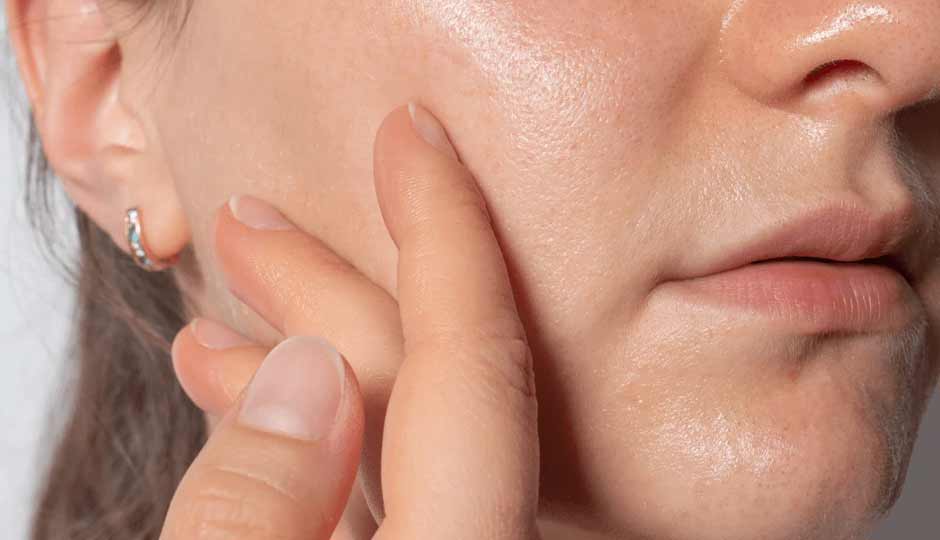10 Home Remedies to Treat Excess Oily Skin